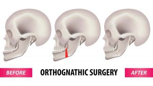 جراحی ارتوگناتیک یا جراحی فک چه مزایایی دارد؟
