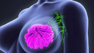روش تشخیص سرطان پستان