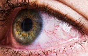 قرمزی چشم چه عللی دارد، چگونه می‌توان آن را درمان و پیشگیری کرد