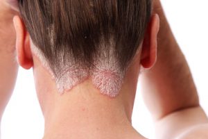 زخم پوست سر نشانه چیست و چگونه کنترل و درمان می‌شود؟